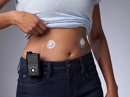 MiniMed Mio® Advance Clear Infusion Set-In Use
